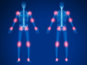 Arthritis locations in the body